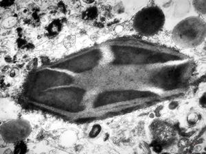 M,15y. | eosinophilic granuloma - Charcot-Leyden crystal M,15y. | eosinophilic granuloma - Charcot-Leyden crystal